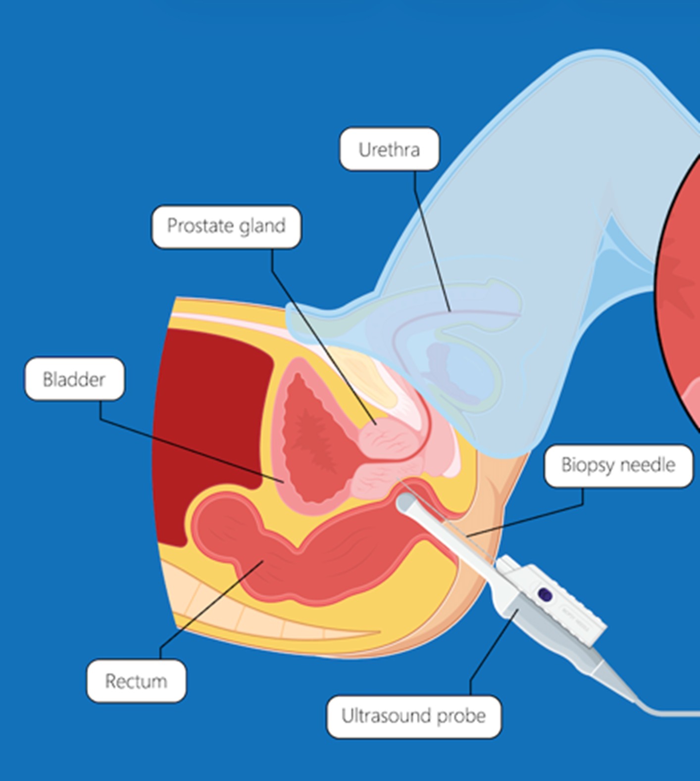 cancer de la prostate